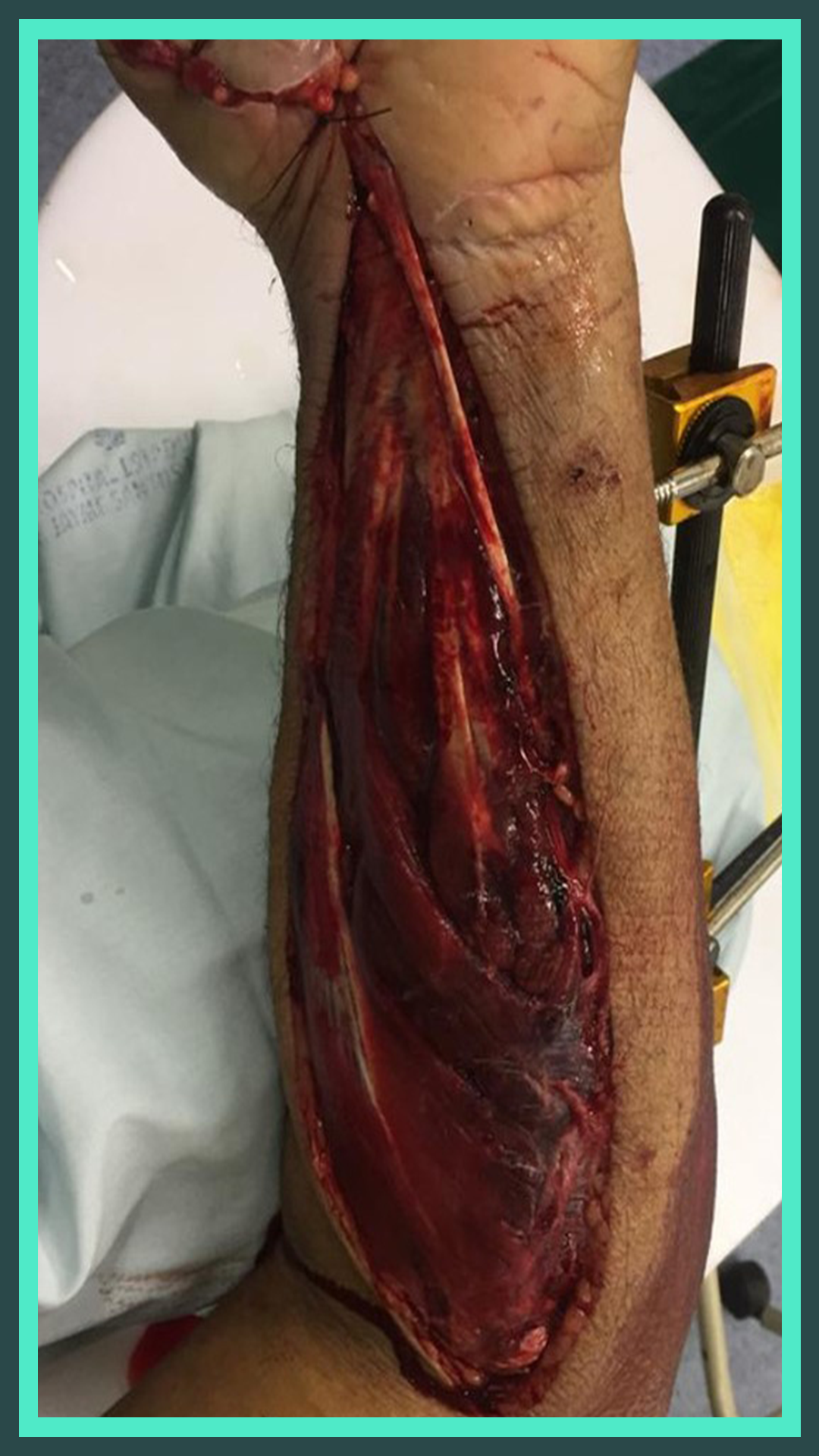 Uso da Técnica de Figueiredo em Fasciotomias. - 2