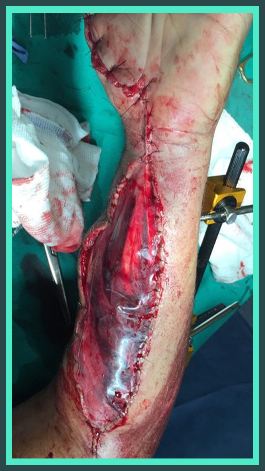 Uso da Técnica de Figueiredo em Fasciotomias. - 3