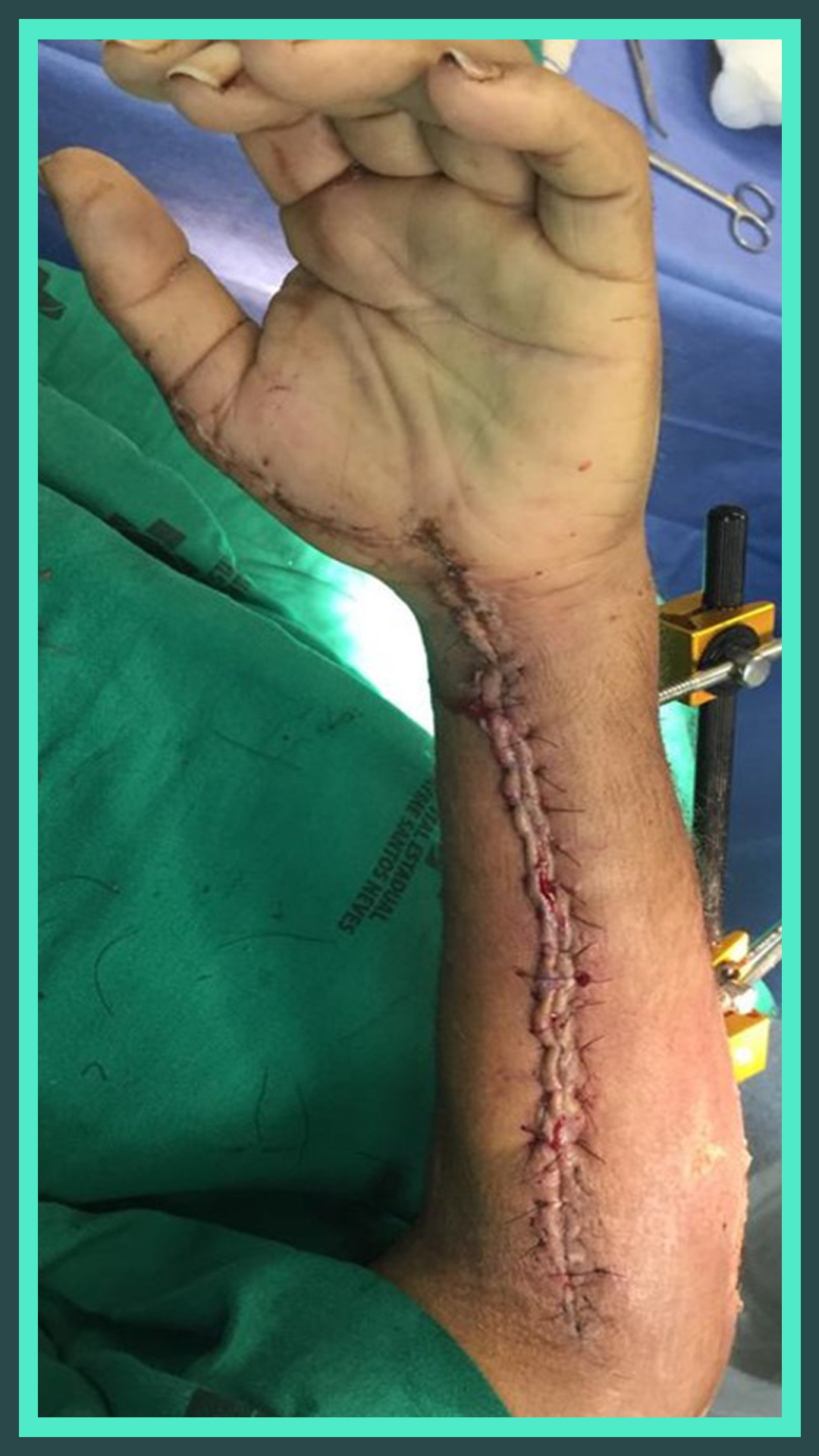 Uso da Técnica de Figueiredo em Fasciotomias. - 4